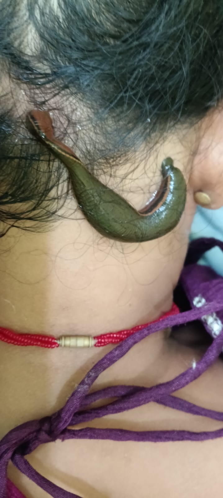 Jalaukavacharana Ayurvedic therapy